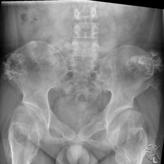 Chondrosarcoma Cases and Medical Insights | Figure 1