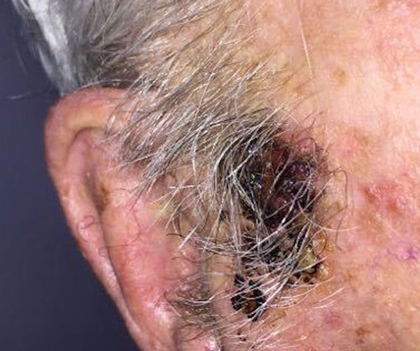 should-this-87-year-old-s-suspected-melanoma-be-treated