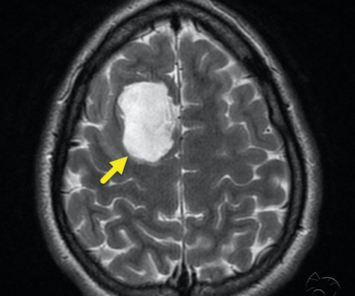 Epidermoid Cyst Intratesticular Benign Epidermoid Cyst