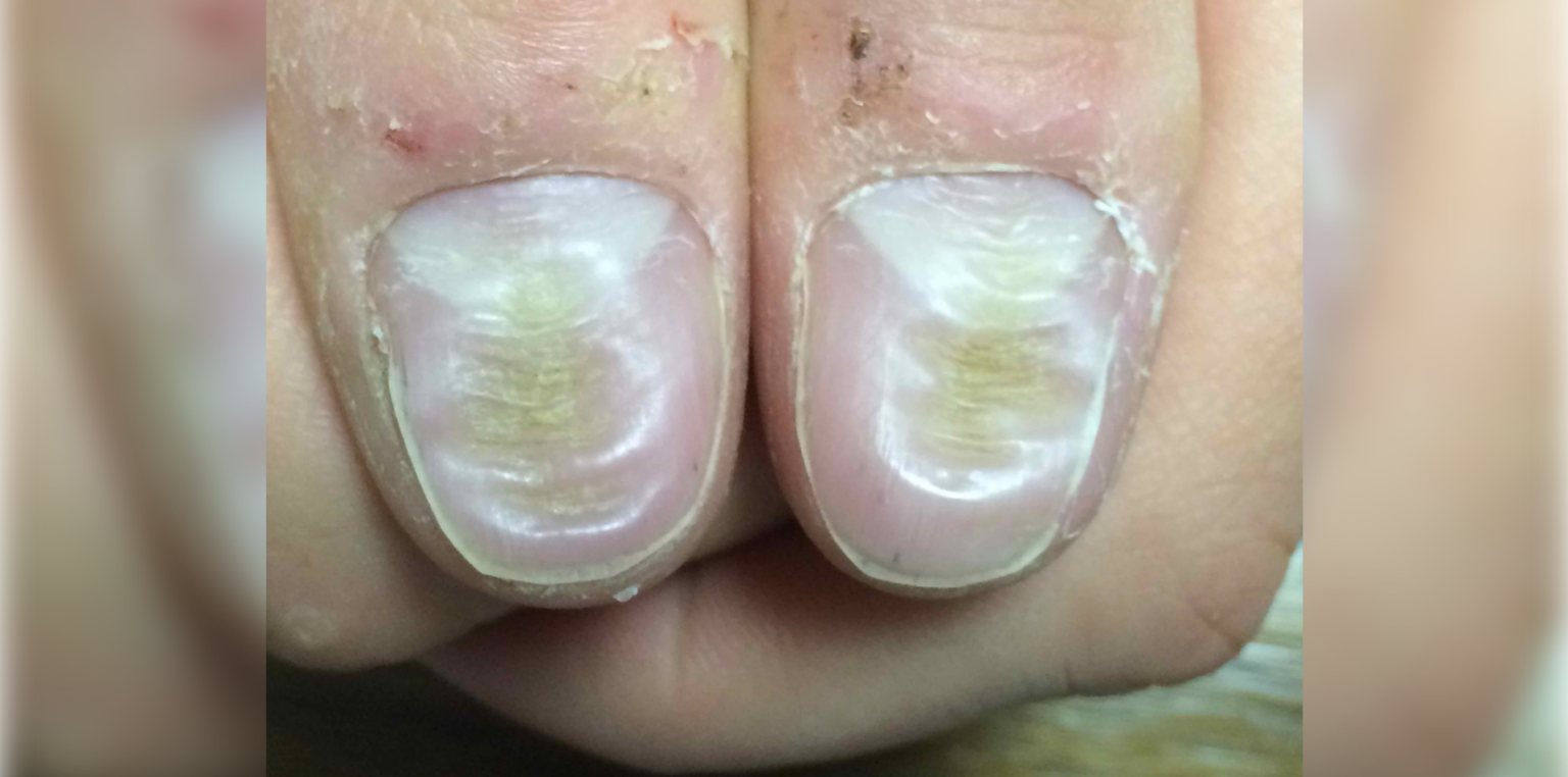 median-nail-dystrophy-and-habit-tic-deformity-figure-1