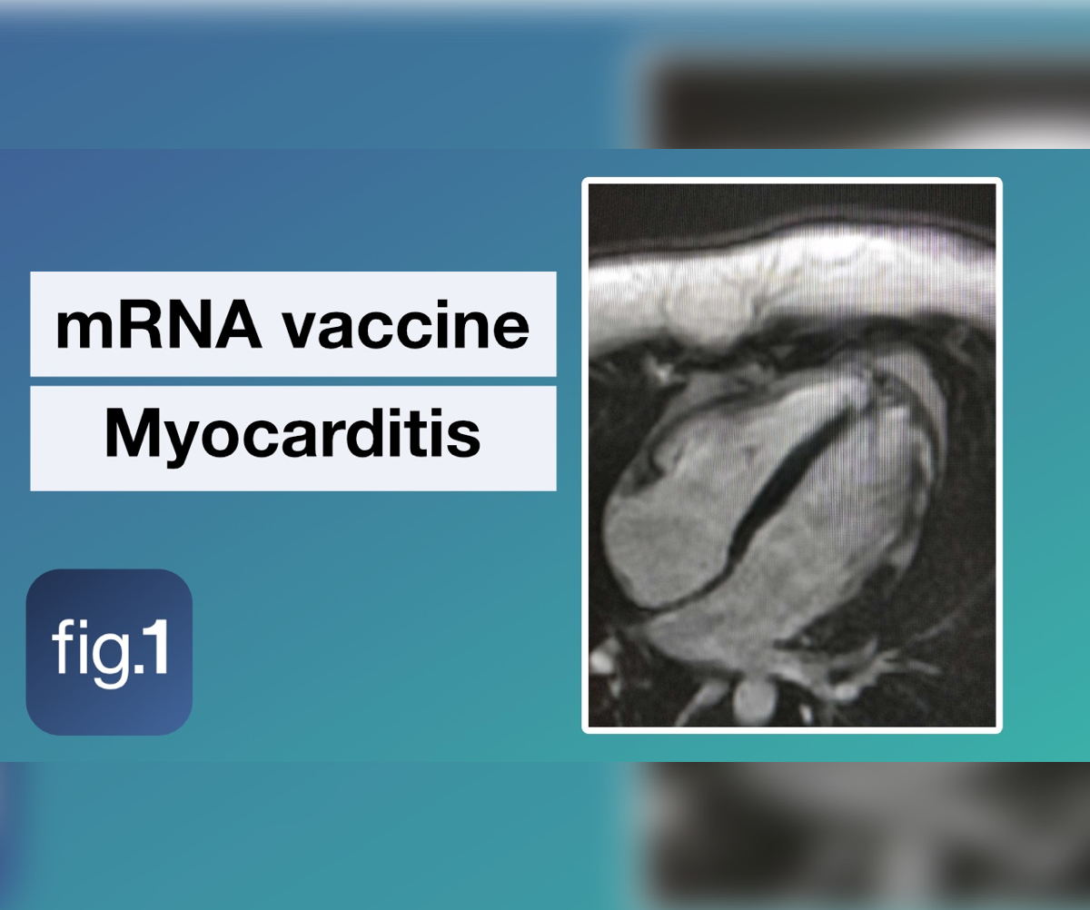 Myocarditis And COVID 19 MRNA Vaccines Figure 1   Myocarditis And COVID 19 MRNA Vaccines 600x501 1 