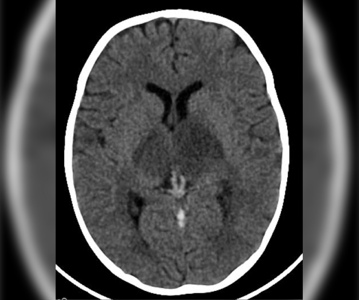 cortical vein thrombosis